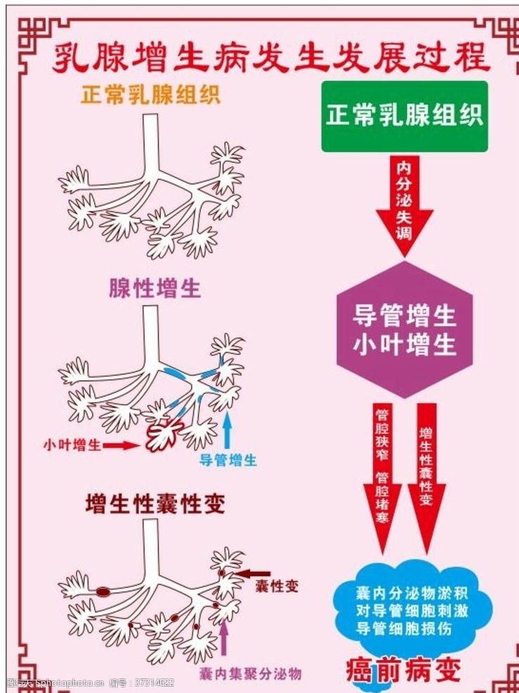 癌变乳腺增生病发过程