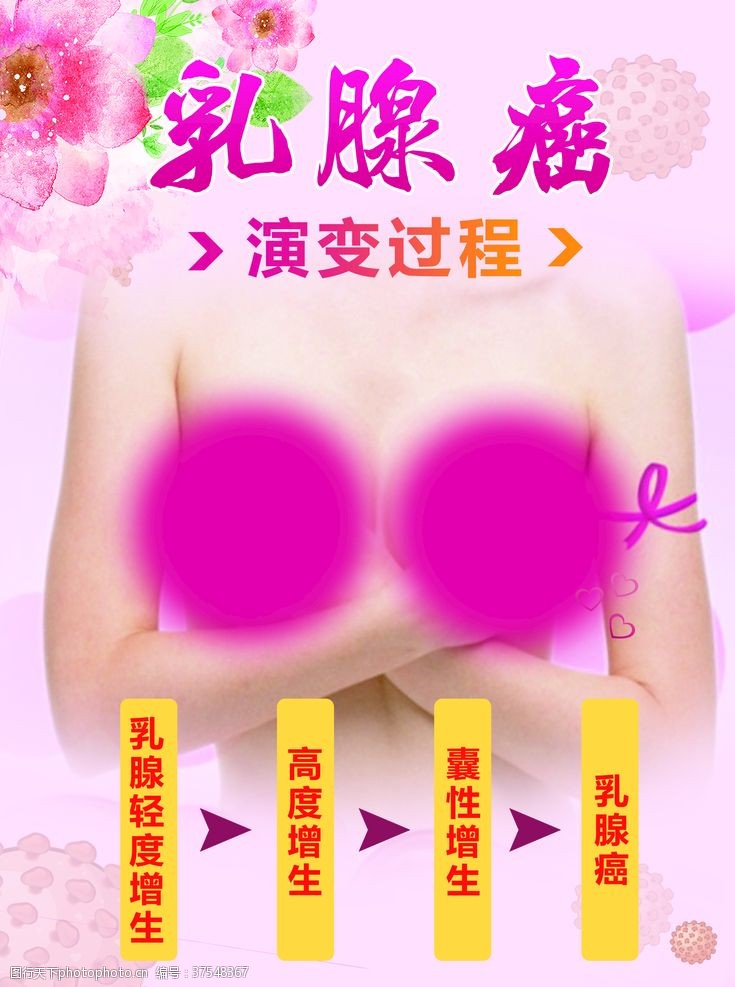 版面设计乳腺癌演变过程